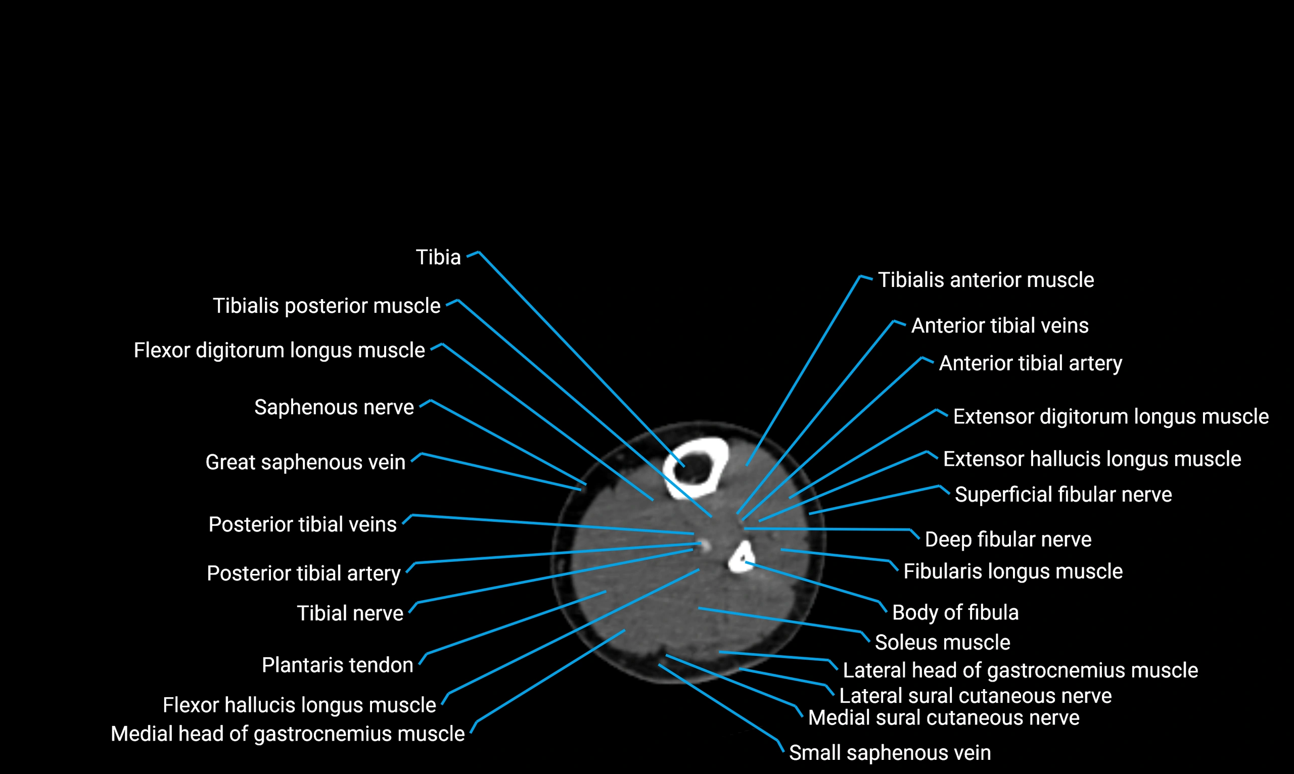 CT lower limb axial cross sectional anatomy labelled image 115 (2).webp